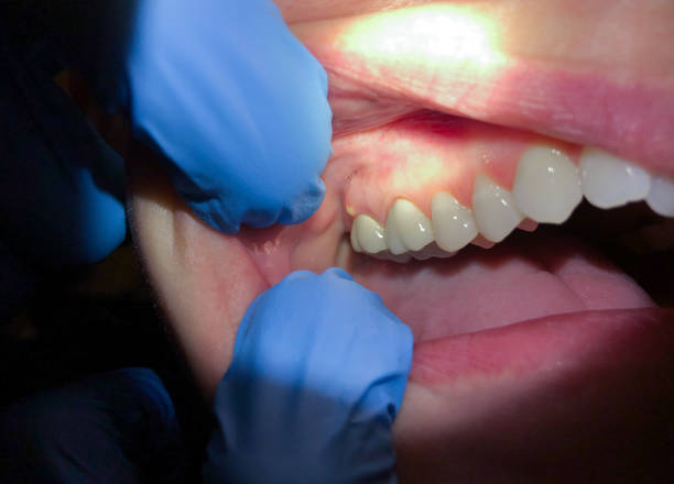 Best Knocked-Out Tooth (Avulsed Tooth) Treatment in Pemberville, OH